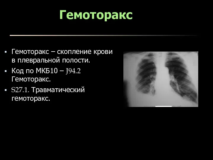 Гемоторакс Гемоторакс – скопление крови в плевральной полости. Код по