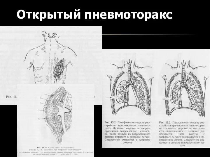 Открытый пневмоторакс