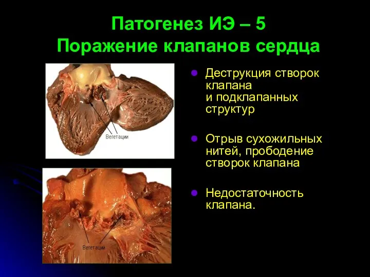 Патогенез ИЭ – 5 Поражение клапанов сердца Деструкция створок клапана