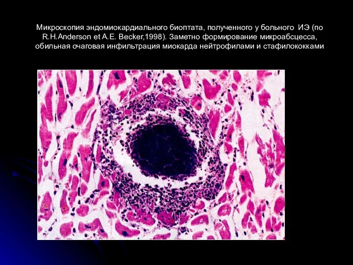 Микроскопия эндомиокардиального биоптата, полученного у больного ИЭ (по R.H.Anderson et