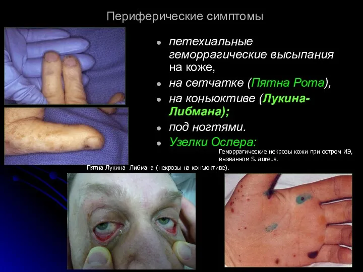 Периферические симптомы петехиальные геморрагические высыпания на коже, на сетчатке (Пятна
