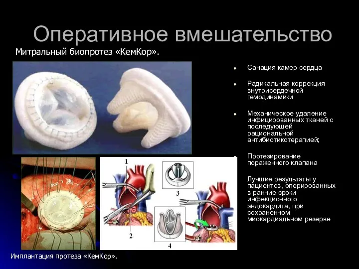 Оперативное вмешательство Санация камер сердца Радикальная коррекция внутрисердечной гемодинамики Механическое