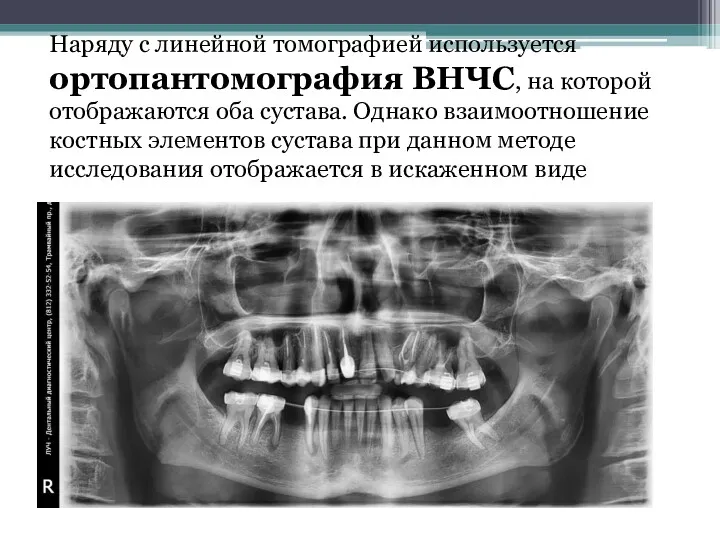 Наряду с линейной томографией используется ортопантомография ВНЧС, на которой отображаются оба сустава. Однако
