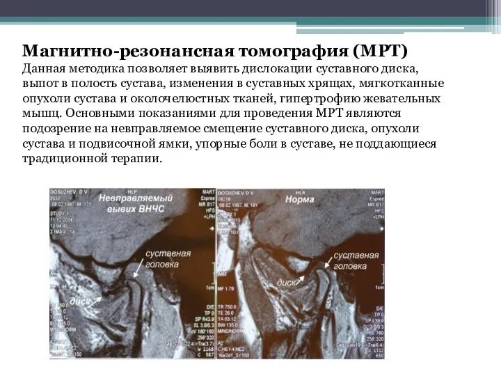 Магнитно-резонансная томография (МРТ) Данная методика позволяет выявить дислокации суставного диска, выпот в полость