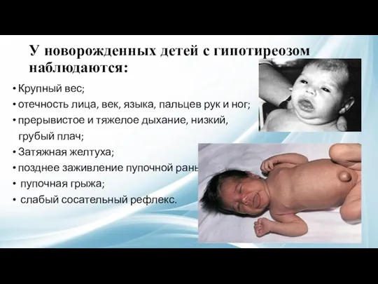 У новорожденных детей с гипотиреозом наблюдаются: Крупный вес; отечность лица, век, языка, пальцев
