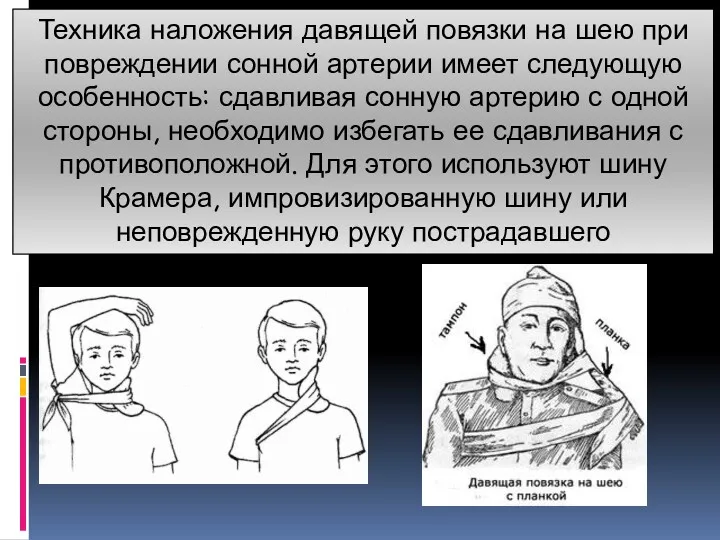 Техника наложения давящей повязки на шею при повреждении сонной артерии