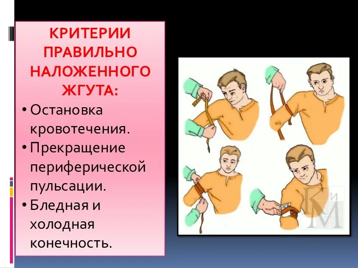 КРИТЕРИИ ПРАВИЛЬНО НАЛОЖЕННОГО ЖГУТА: Остановка кровотечения. Прекращение периферической пульсации. Бледная и холодная конечность.