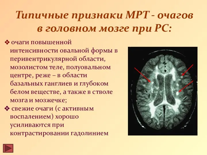 Типичные признаки МРТ - очагов в головном мозге при РС: