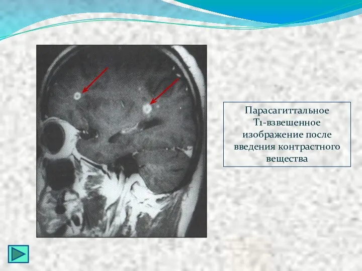 Парасагиттальное Т1-взвешенное изображение после введения контрастного вещества