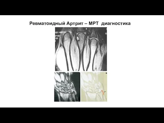 Ревматоидный Артрит – МРТ диагностика