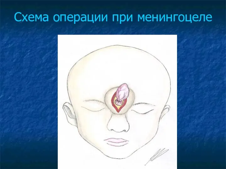 Схема операции при менингоцеле