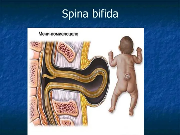 Spina bifida