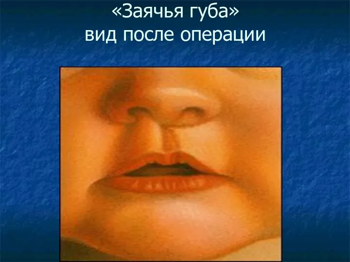«Заячья губа» вид после операции