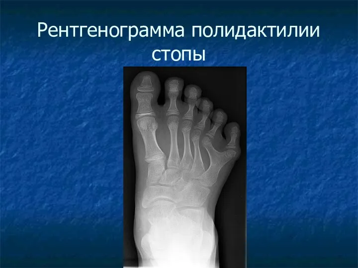 Рентгенограмма полидактилии стопы