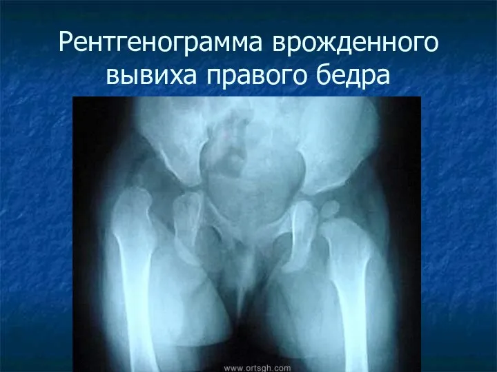 Рентгенограмма врожденного вывиха правого бедра