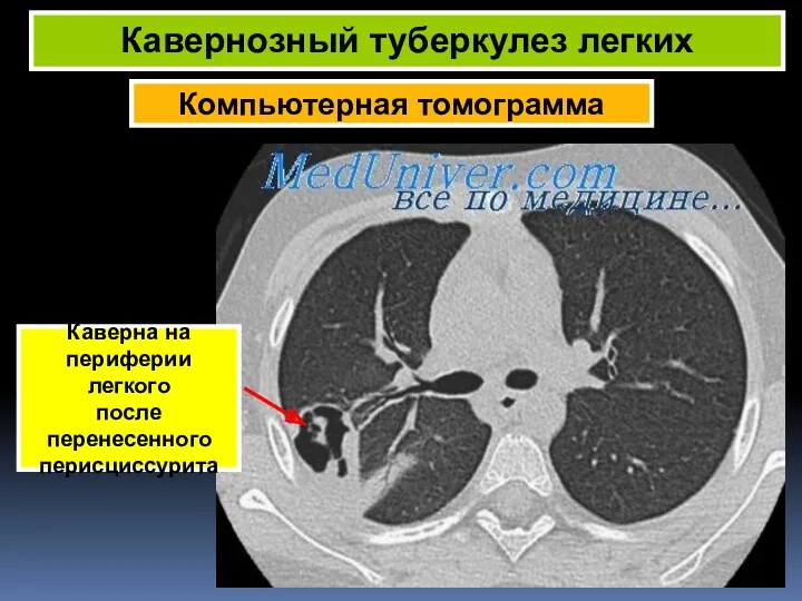 Компьютерная томограмма Кавернозный туберкулез легких Каверна на периферии легкого после перенесенного перисциссурита