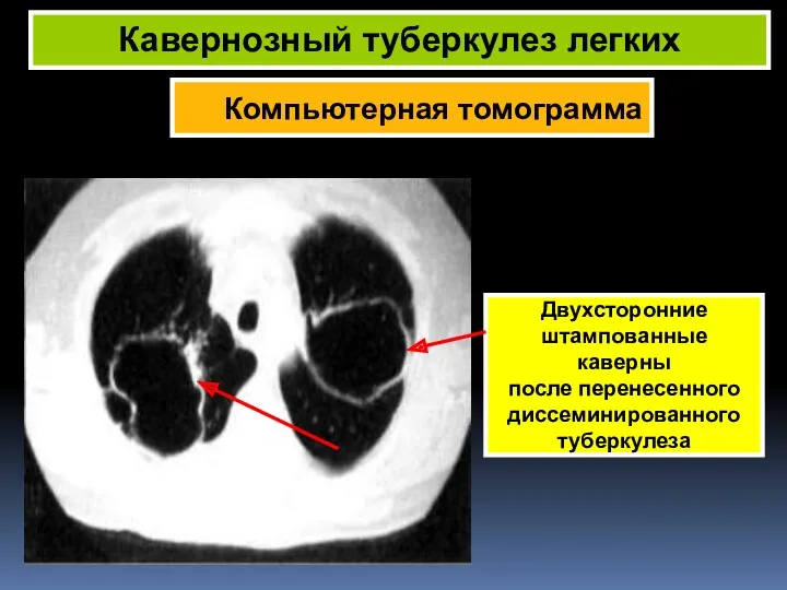 Компьютерная томограмма Кавернозный туберкулез легких Двухсторонние штампованные каверны после перенесенного диссеминированного туберкулеза