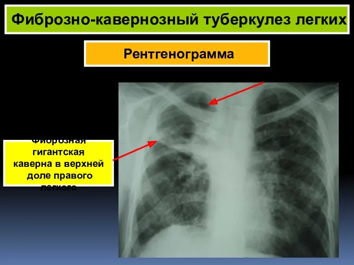 Рентгенограмма Фиброзно-кавернозный туберкулез легких Фиброзная гигантская каверна в верхней доле правого легкого