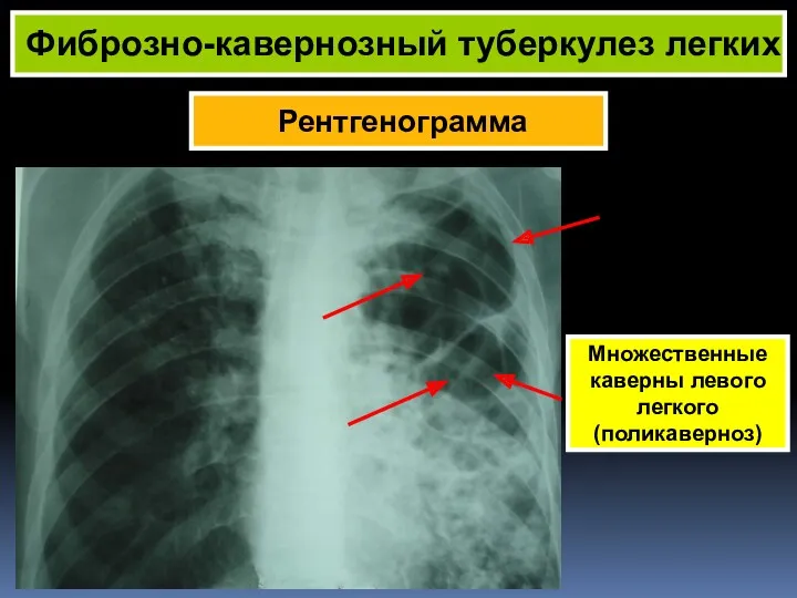 Рентгенограмма Фиброзно-кавернозный туберкулез легких Множественные каверны левого легкого (поликаверноз)