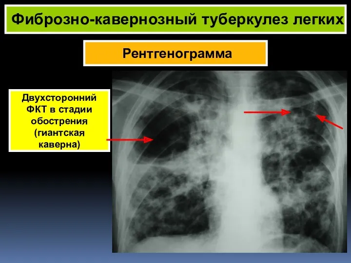 Рентгенограмма Фиброзно-кавернозный туберкулез легких Двухсторонний ФКТ в стадии обострения (гиантская каверна)