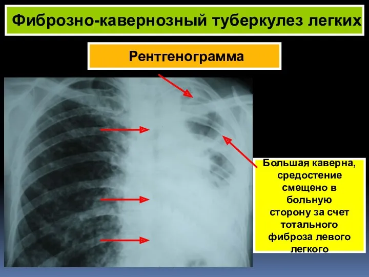 Рентгенограмма Фиброзно-кавернозный туберкулез легких Большая каверна, средостение смещено в больную