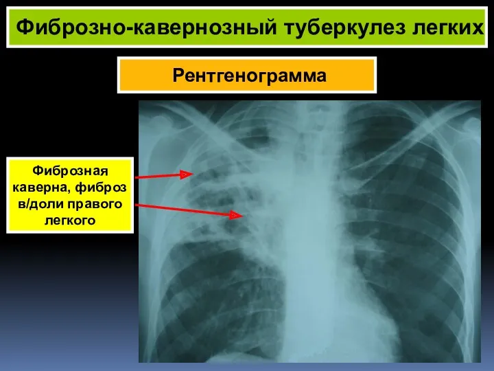 Рентгенограмма Фиброзно-кавернозный туберкулез легких Фиброзная каверна, фиброз в/доли правого легкого