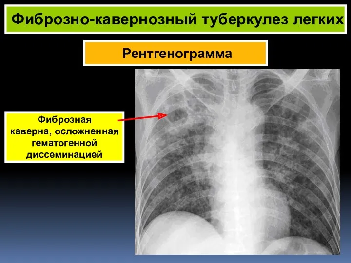 Рентгенограмма Фиброзно-кавернозный туберкулез легких Фиброзная каверна, осложненная гематогенной диссеминацией