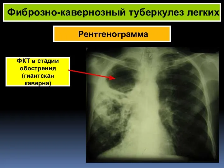 Рентгенограмма Фиброзно-кавернозный туберкулез легких ФКТ в стадии обострения (гиантская каверна)