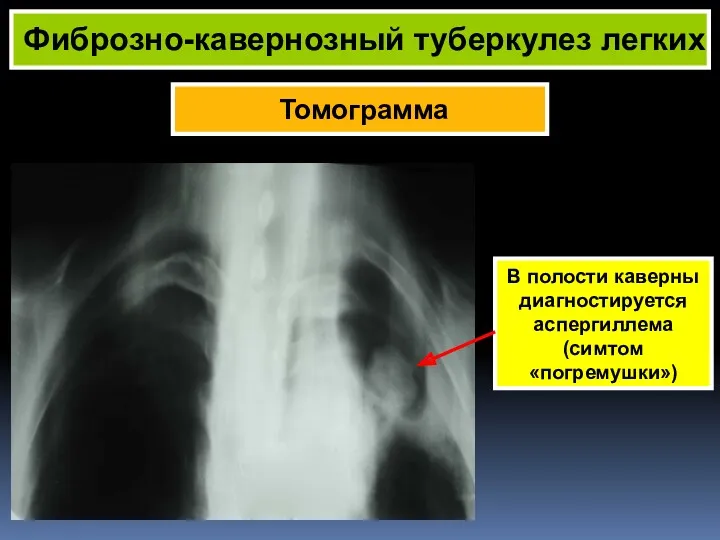 Томограмма Фиброзно-кавернозный туберкулез легких В полости каверны диагностируется аспергиллема (симтом «погремушки»)