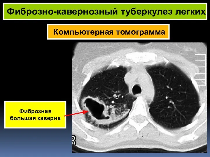 Компьютерная томограмма Фиброзно-кавернозный туберкулез легких Фиброзная большая каверна