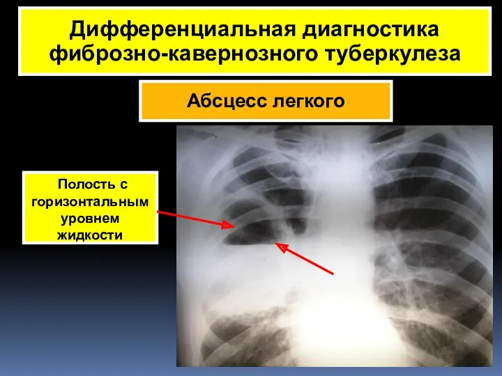 Абсцесс легкого Дифференциальная диагностика фиброзно-кавернозного туберкулеза Полость с горизонтальным уровнем жидкости