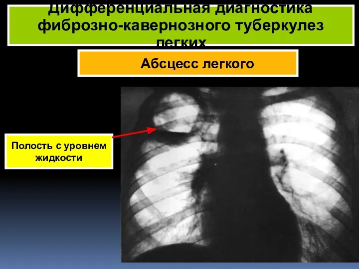 Абсцесс легкого Дифференциальная диагностика фиброзно-кавернозного туберкулез легких Полость с уровнем жидкости