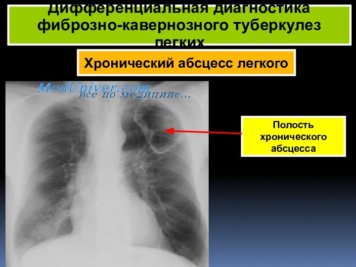 Хронический абсцесс легкого Дифференциальная диагностика фиброзно-кавернозного туберкулез легких Полость хронического абсцесса