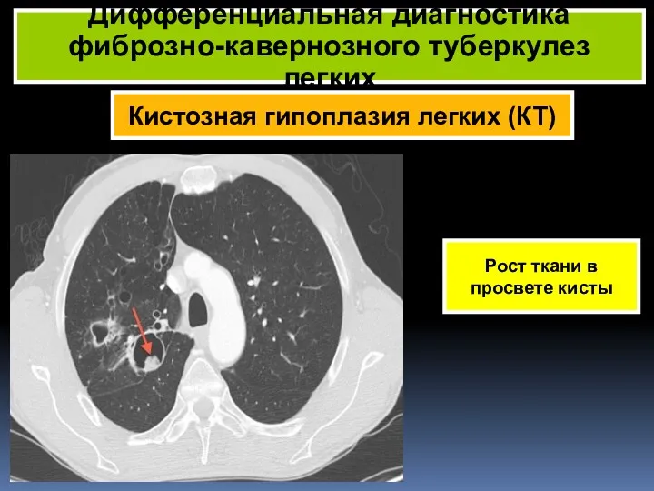 Кистозная гипоплазия легких (КТ) Дифференциальная диагностика фиброзно-кавернозного туберкулез легких Рост ткани в просвете кисты