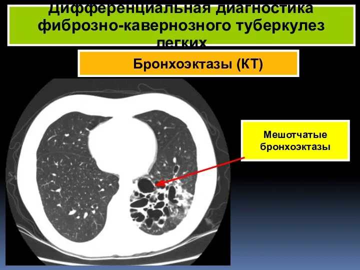 Бронхоэктазы (КТ) Дифференциальная диагностика фиброзно-кавернозного туберкулез легких Мешотчатые бронхоэктазы