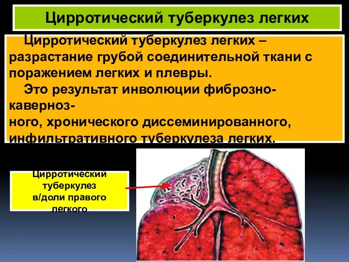 Цирротический туберкулез легких – разрастание грубой соединительной ткани с поражением