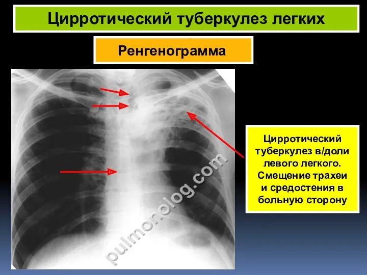 Ренгенограмма Цирротический туберкулез легких Цирротический туберкулез в/доли левого легкого. Смещение трахеи и средостения в больную сторону