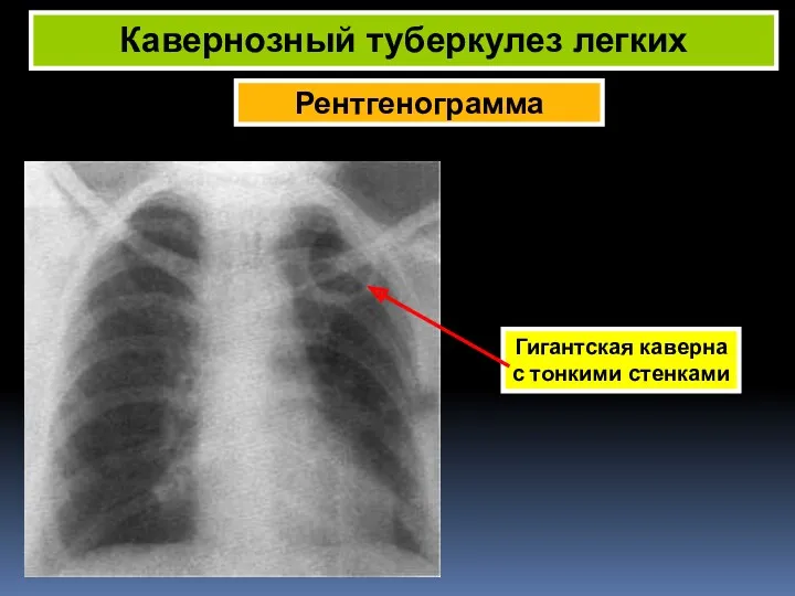 Рентгенограмма Кавернозный туберкулез легких Гигантская каверна с тонкими стенками