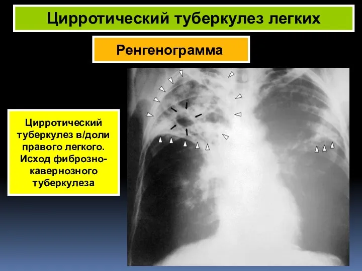 Ренгенограмма Цирротический туберкулез легких Цирротический туберкулез в/доли правого легкого. Исход фиброзно- кавернозного туберкулеза