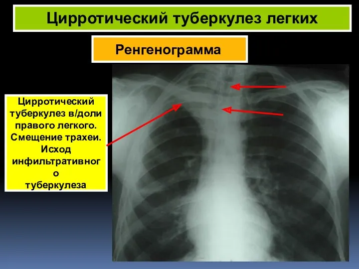 Ренгенограмма Цирротический туберкулез легких Цирротический туберкулез в/доли правого легкого. Смещение трахеи. Исход инфильтративного туберкулеза