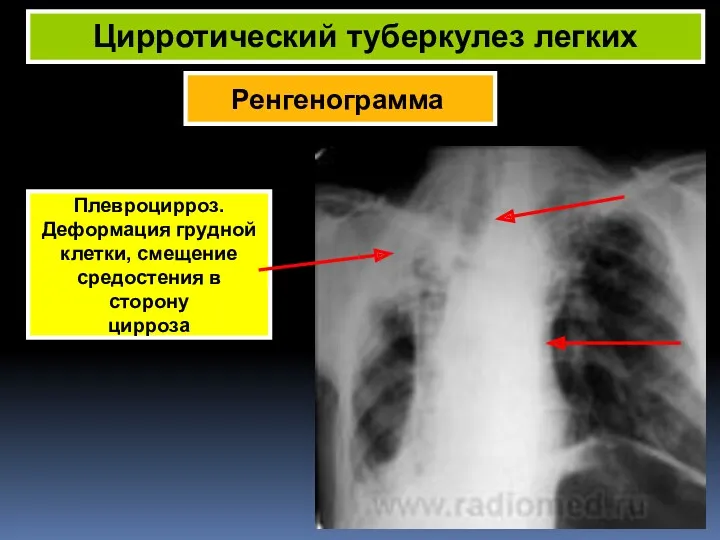 Ренгенограмма Цирротический туберкулез легких Плевроцирроз. Деформация грудной клетки, смещение средостения в сторону цирроза