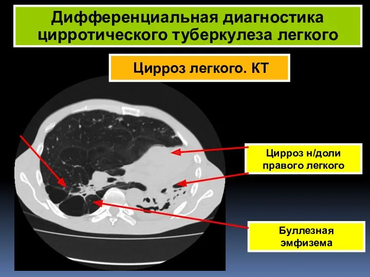 Дифференциальная диагностика цирротического туберкулеза легкого Цирроз н/доли правого легкого Буллезная эмфизема Цирроз легкого. КТ