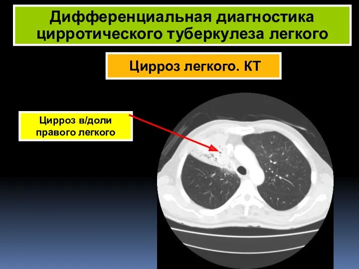 Дифференциальная диагностика цирротического туберкулеза легкого Цирроз в/доли правого легкого Цирроз легкого. КТ