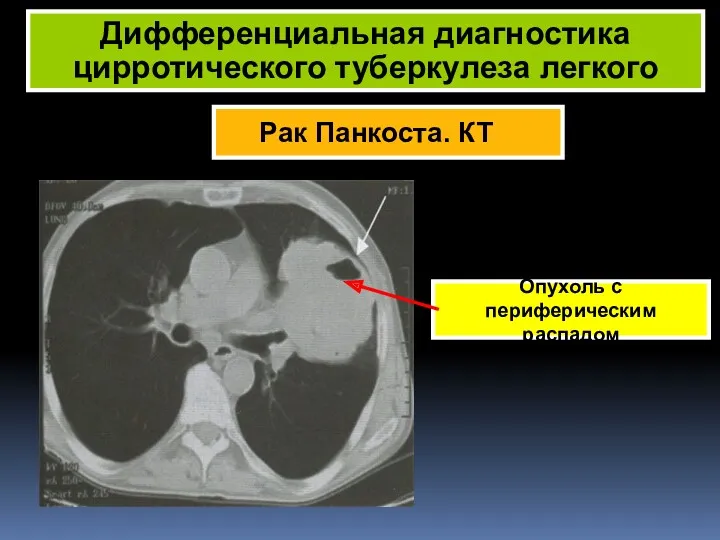 Дифференциальная диагностика цирротического туберкулеза легкого Опухоль с периферическим распадом Рак Панкоста. КТ