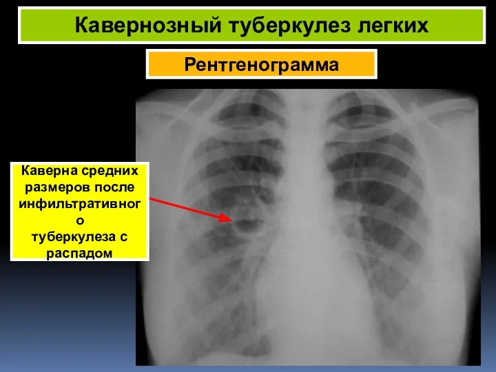 Рентгенограмма Кавернозный туберкулез легких Каверна средних размеров после инфильтративного туберкулеза c распадом