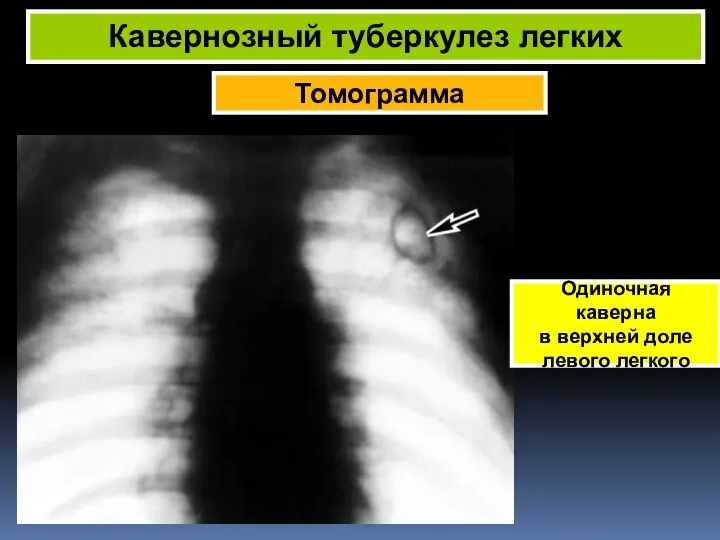 Томограмма Кавернозный туберкулез легких Одиночная каверна в верхней доле левого легкого