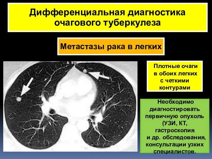Метастазы рака в легких Дифференциальная диагностика очагового туберкулеза Плотные очаги в обоих легких