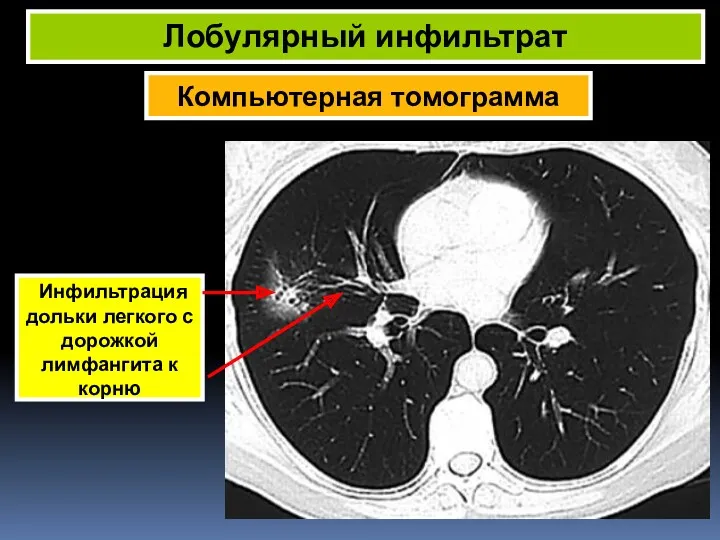 Компьютерная томограмма Лобулярный инфильтрат Инфильтрация дольки легкого с дорожкой лимфангита к корню