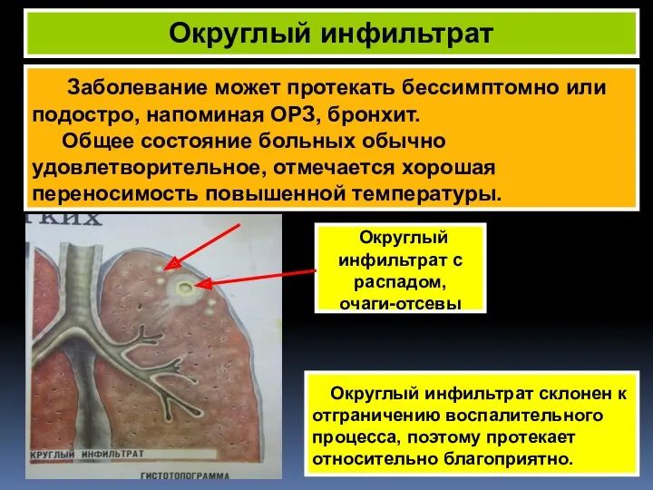 Заболевание может протекать бессимптомно или подостро, напоминая ОРЗ, бронхит. Общее состояние больных обычно