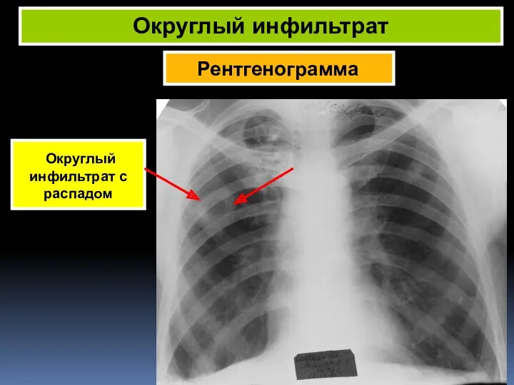 Рентгенограмма Округлый инфильтрат Округлый инфильтрат с распадом